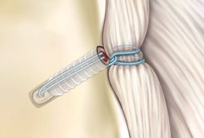 Labrum-repair mit Push-lock